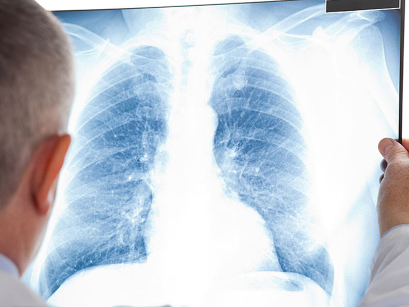 Un médico examina una radiografía de tórax, destacando la importancia del diagnóstico y tratamiento de enfermedades pulmonares.